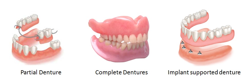 Dentures Family Dentistry in Santa Cruz Calif